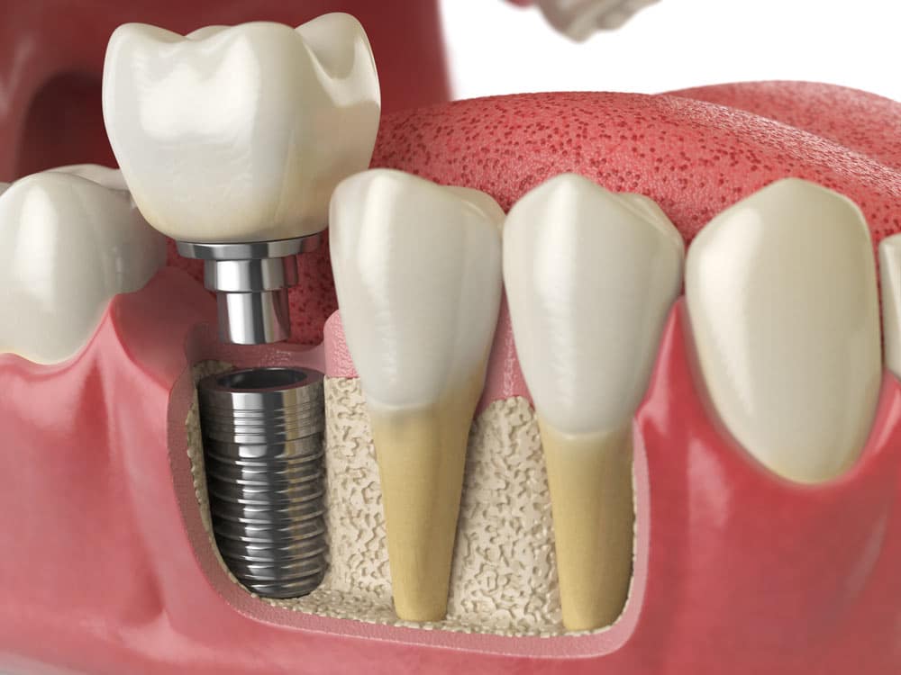 Implant Restorations Implant Restorations